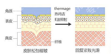 热玛吉一次多少钱?价格费用明细、功效作用揭晓!