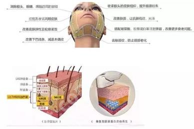 热玛吉的功效作用及副作用有什么?要注意哪些呢?