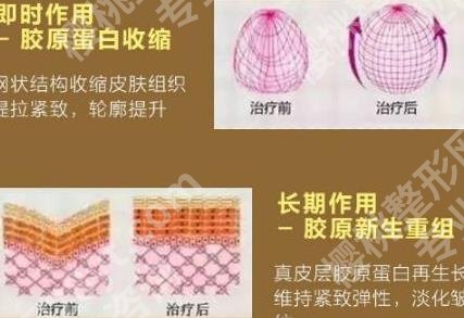 热玛吉的功效作用及副作用有什么?要注意哪些呢?