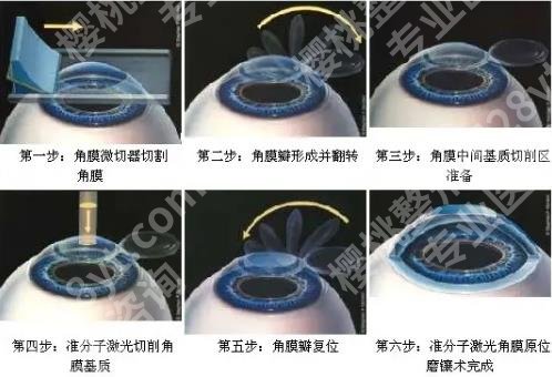 准分子激光近视手术原理是什么?有哪些优势和弊端