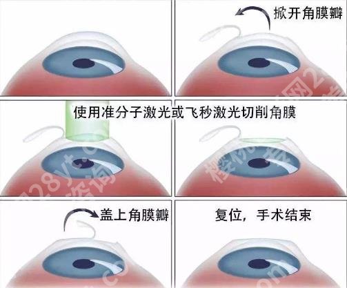 准分子激光近视手术原理是什么?有哪些优势和弊端