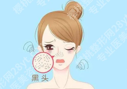 黑头怎么去掉?这些方法你get了吗?