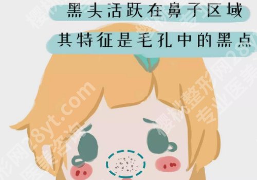 黑头怎么去掉?这些方法你get了吗?