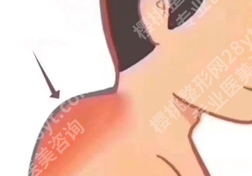 东方和谐冯斌做富贵包怎么样?内附医生手术案例!
