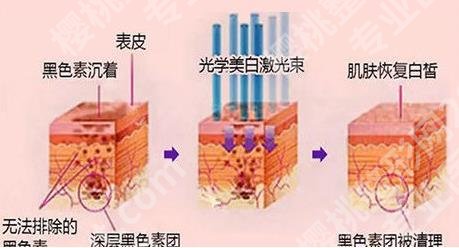 光子嫩肤后注意事项有哪些?几天恢复较好的状态?