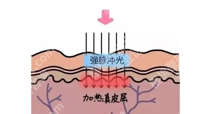 光子嫩肤后注意事项有哪些?几天恢复较好的状态?