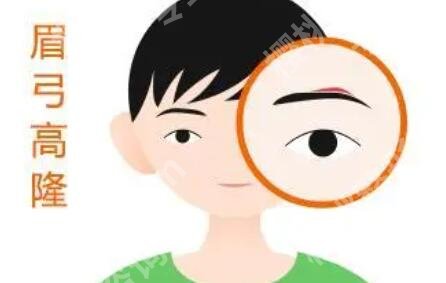 成都心悦容倪云志眉弓怎么样?真人隆眉弓效果图展示!