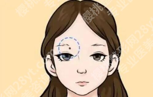 痦子怎么去除?激光效果如何?大概几天可以恢复?