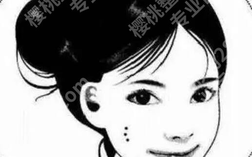 痦子怎么去除?激光效果如何?大概几天可以恢复?