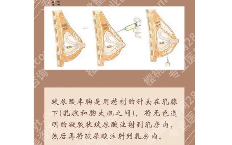 梅州中医医院隆胸多少钱?全新价格表、医生名单一览
