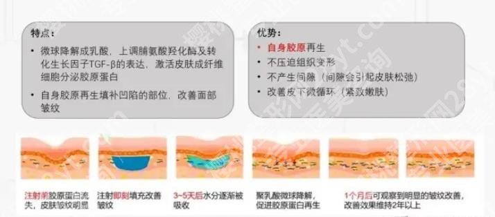 艾维岚注射后多久消肿?可以保持多久?附注意事项等介绍