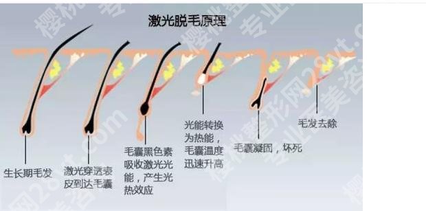 激光脱腋毛可以永久去除吗?优势、弊端等在线分析!