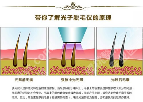 激光脱腋毛可以永久去除吗?优势、弊端等在线分析!