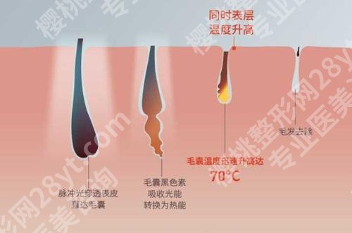 激光脱腋毛可以永久去除吗?优势、弊端等在线分析!