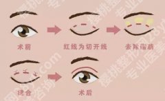 韩式定点双眼皮跟埋线的区别在哪？各优势分析！