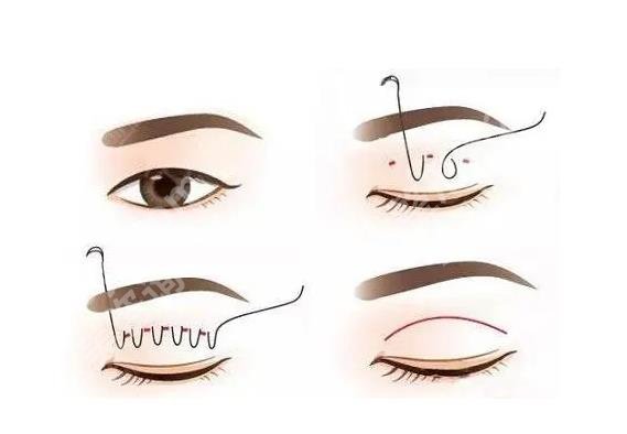 韩式定点双眼皮跟埋线的区别在哪？各优势分析！