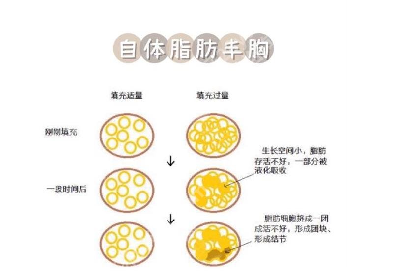 长春脂肪填充胸部怎么收费?2023价格明细\脂肪隆胸科普