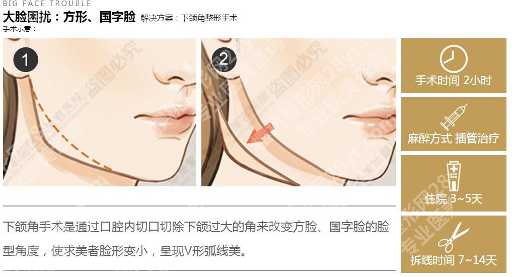 何照华磨骨案例评价:线条柔和自然!内附医生信息、手术价格