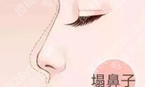 北京八大处做鼻综合大概多少钱?人气医生与鼻部综合案例