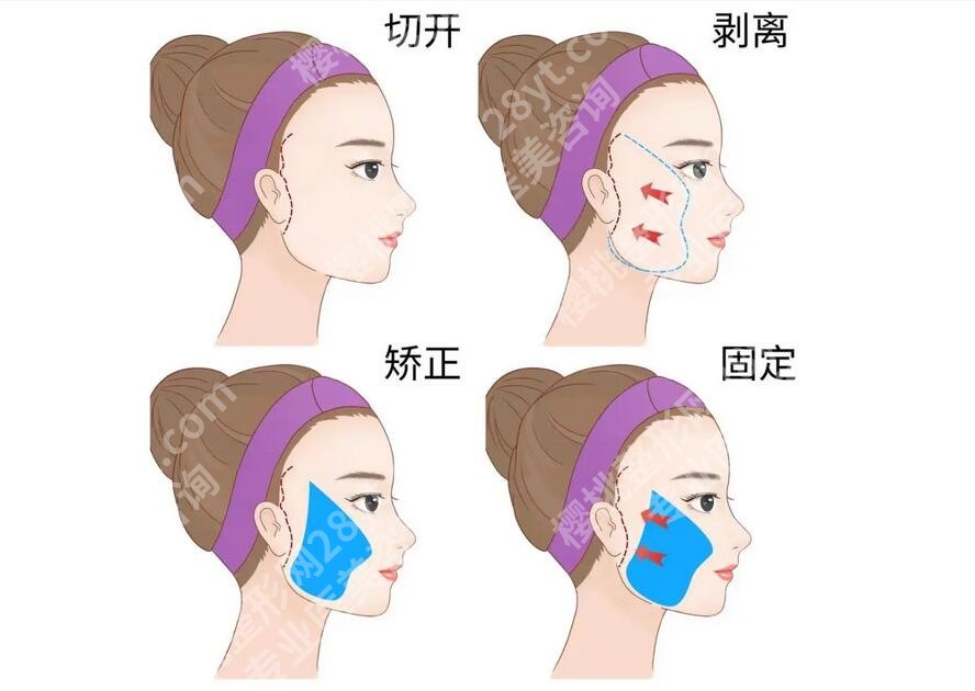 高亚东做拉皮手术好吗?个人资料简介、真人拉皮案例揭晓!术前必看