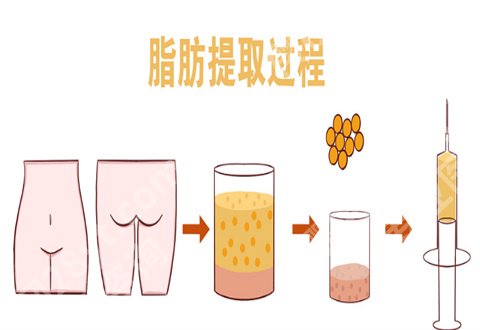 北京王明利自体脂肪填充怎么样?案例反馈+医生介绍
