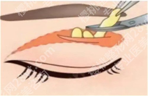 北京王博谦双眼皮怎么样?看真人案例评价