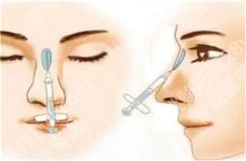 魏皎鼻子案例在线查看!看真人反馈点评