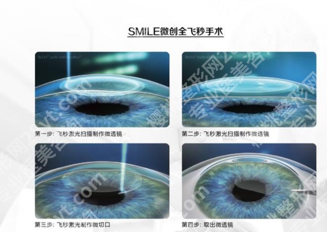 眼睛近视到多少度会瞎?预防近视的方法、手法方式超全盘点!