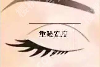 北京艺星双眼皮多少钱?医院实力点评|全新收费标准更新!