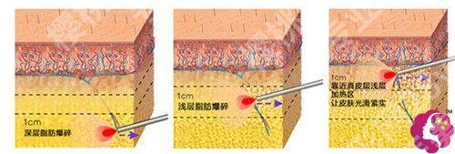如何减去腹部赘肉有效?腹部吸脂后会反弹吗?