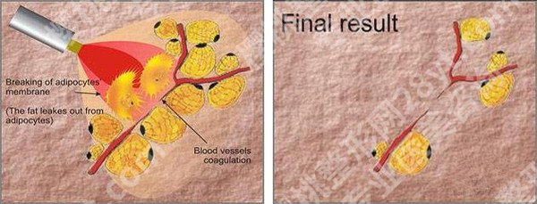 如何减去腹部赘肉有效?腹部吸脂后会反弹吗?