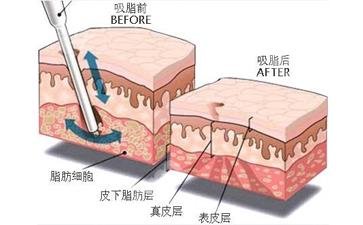 如何减去腹部赘肉有效?腹部吸脂后会反弹吗?