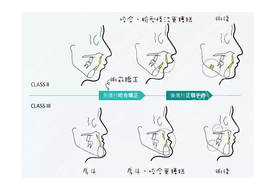 章建林正颌手术怎么样?口碑|收费详细|案例图反馈