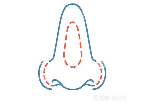 杭州假体隆鼻要多少钱?不适感会减轻吗?