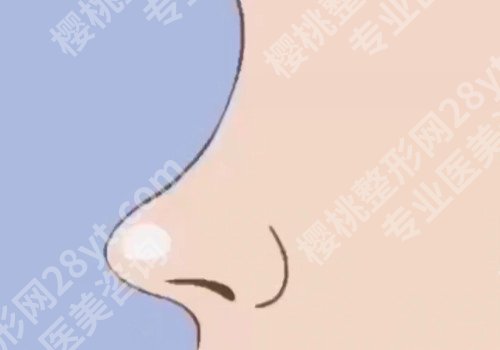昆明肋骨鼻子大概多少钱?操作麻不麻烦?