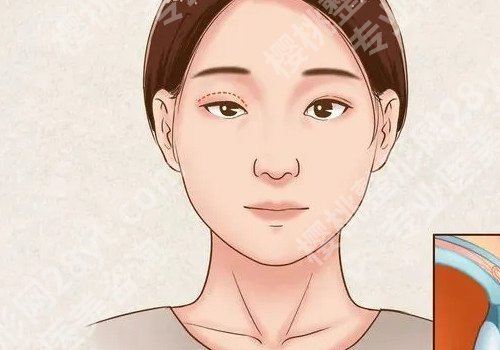 埋线双眼皮可以保持几年?操作原理有什么?