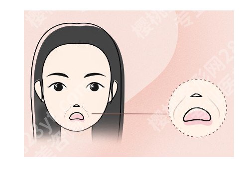 去法令纹针会有什么后遗症?可以保持多长时间?一起为大家揭秘!