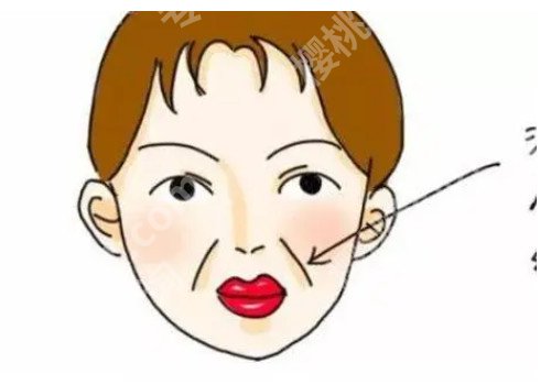 去法令纹针会有什么后遗症?可以保持多长时间?一起为大家揭秘!