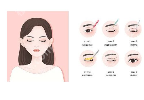 上海割双眼皮需要多少钱一次?多久可以恢复?注意事项有什么?