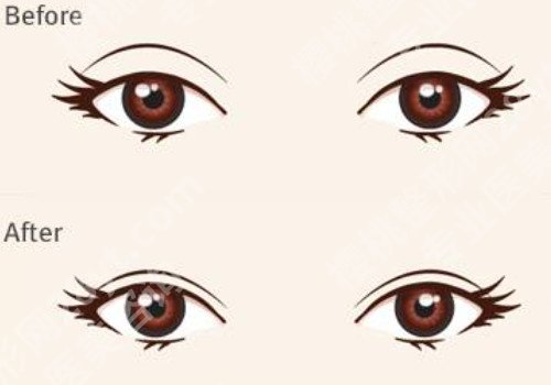 去鱼尾纹一般的价格?多家医院介绍!一起看看吧!