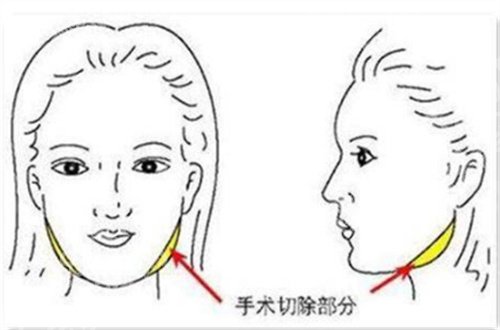 削骨一年后的忠告,真人案例带你看术前、术后变化图