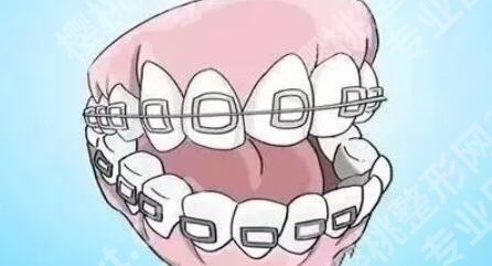 成人尽量不要矫正牙齿？有什么注意事项吗？