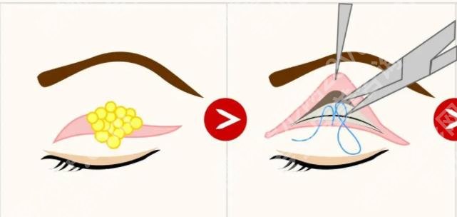 割双眼皮后1-7天恢复图|来看看真人做眼部手术前后对比图吧