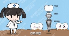 东莞人民医院种植牙多少钱一颗？真人牙齿种植案例