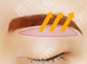北京美莱做筋膜提吊眉多少钱?院内真人吊眉项目案例图分享!