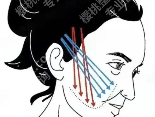 金云波中面部提升案例|医生的真实技术如何?案例图曝光