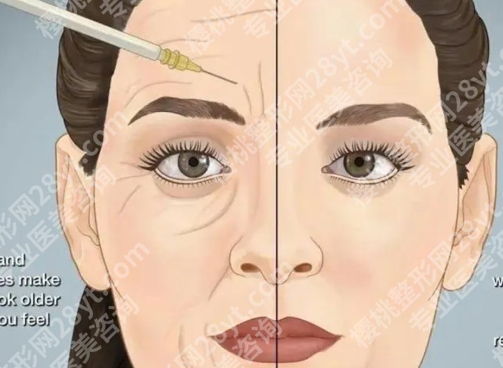 北京画美注射玻尿酸哪位医生技术好?玻尿酸案例分享