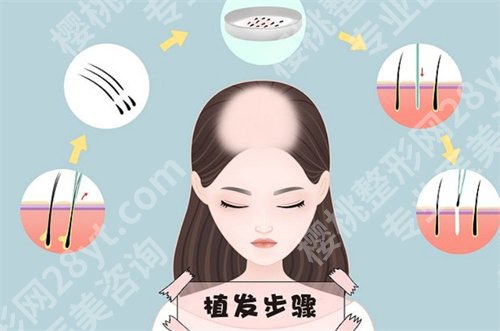 九院吴巍植发怎么样?发际线种植真人案例反馈,戳进来