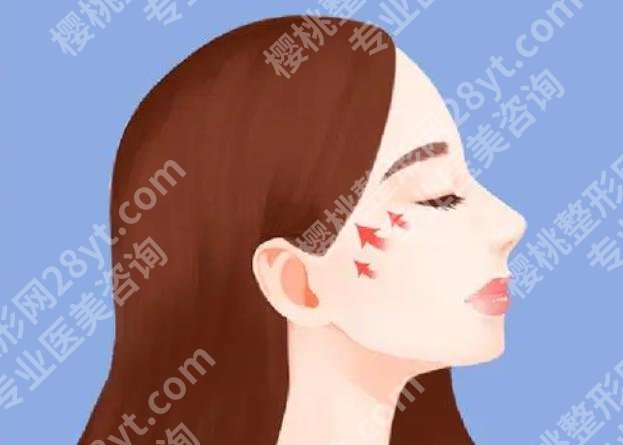 北京何照华磨骨案例图曝光!手术前后小贴士分享!