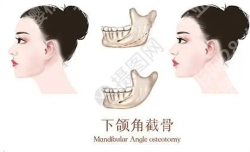 黄大勇做磨骨手术怎么样?网友体验感反馈,口碑不错哦